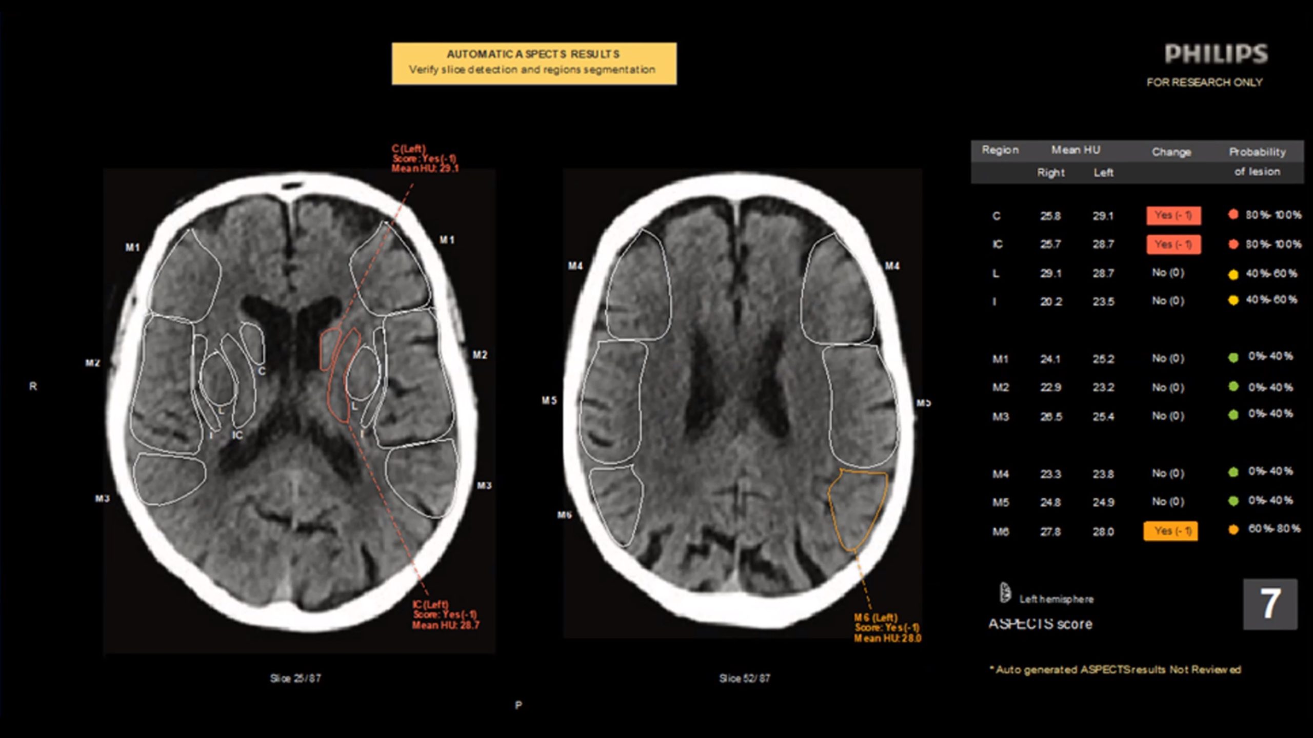 Advanced Visualization Workspace (AVW) – CT ASPECT Scoring 1 (ASPECTS ...